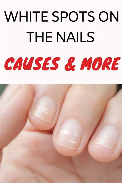 White Spots on the Nails: Causes and More .
